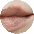 Cold Sore Tingle Stage Cold Sore Tingle Stage