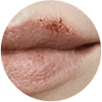 Cold Sore Ulcer Stage Cold Sore Ulcer Stage