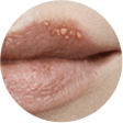 Cold Sore Scabbing Stage Cold Sore Scabbing Stage