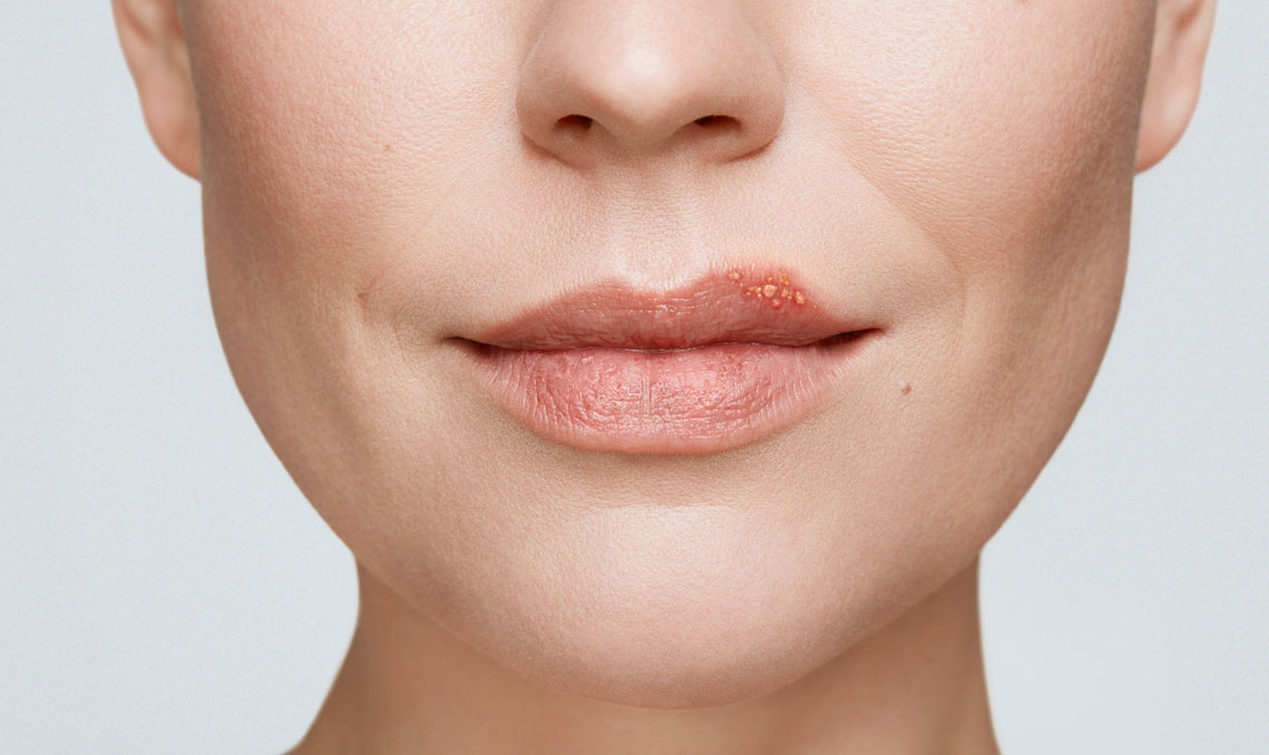 Cold Sores - WebMD